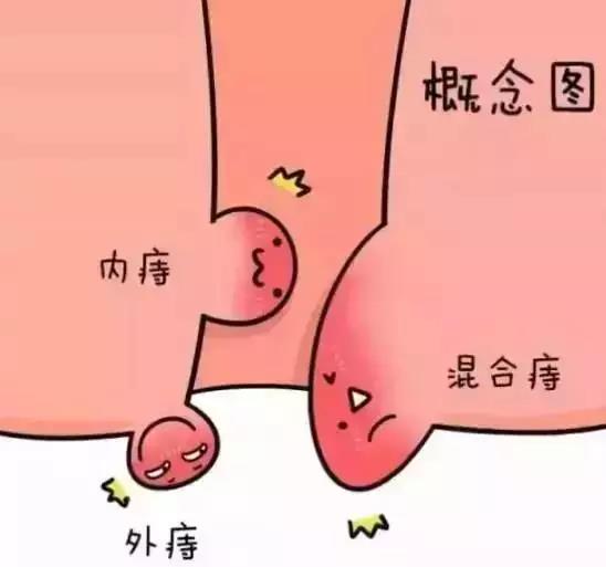 长痔疮早期有什么症状